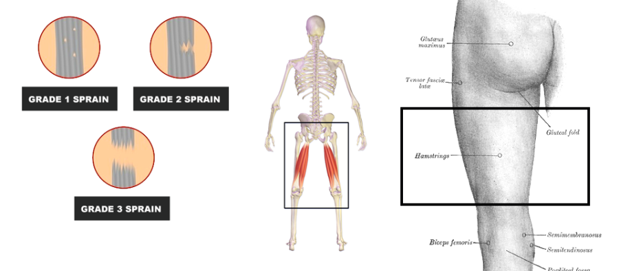 Hamstring Injury: Your Questions Answered